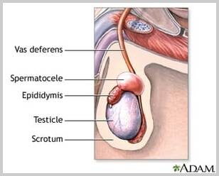 Spermatocele: What it is, causes, treatments